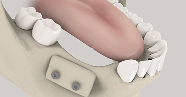 Knochenaufbau und Implantation in zweiter Sitzung